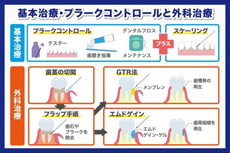 歯周病治療とはどんな治療なのか？｜名古屋歯科 名古屋駅院