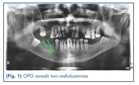 Lingual Foramen Radiograph