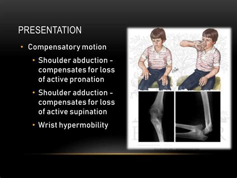 Congenital Radial Ulnar Synostosis.pptx