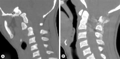 A Preoperative Computed Tomography Ct Bone Window Sagittal View At