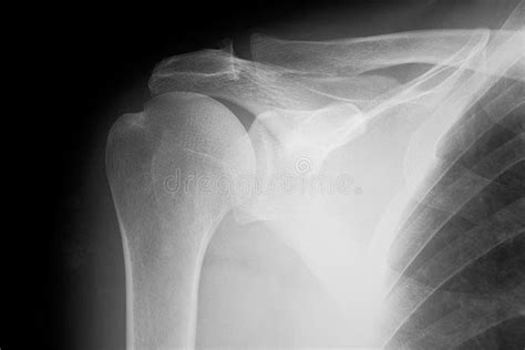 Xray Of Shoulder Radiography Stock Photo Image Of Shoulder