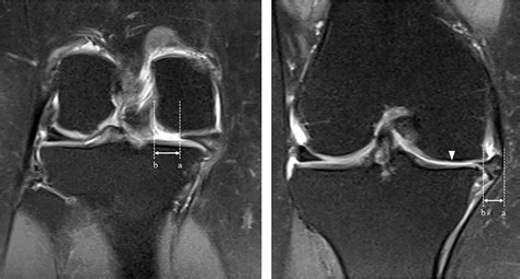 Meniscal Extrusion Cartilage Bone And Ligament Lesions Associated With Medial Meniscus