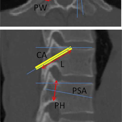 Denis Three Column Model Of Spinal Stability Which Involves Anterior