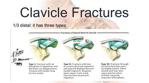 Shoulder Fx And Dislocation