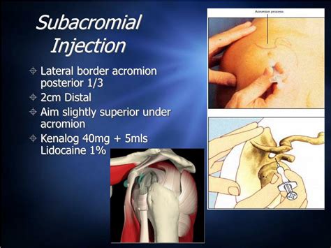 Ppt Shoulder Assessment And Injection Powerpoint Presentation Free