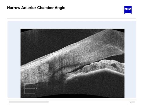 PPT - Normal Anterior Chamber Angle PowerPoint Presentation, free download - ID:4049280