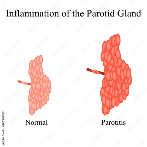 Inflammation of the parotid gland.The structure of the parotid salivary ...