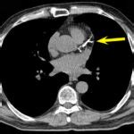 Coronary Calcium Score Asian Heart And Vascular Center