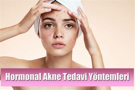 Hormonal Akne Sivilce Nedir Neden Oluşur ve Tedavi Yöntemleri