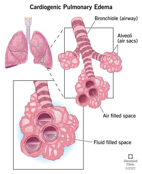 Pulmonary Edema Signs And Symptoms