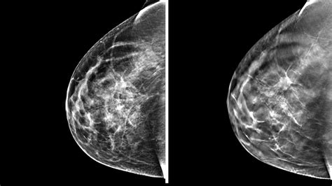 3 D Mammography Finds More Tumors But Questions Remain Minnesota