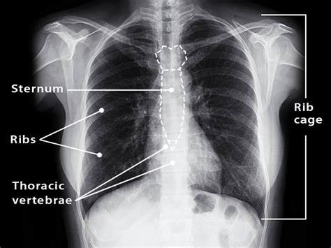 Rib Cage Names Of Bones Anatomy Functions Labeled Diagram