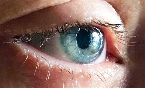 Keratoconus Corneal Transplant