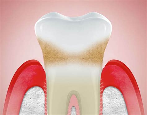 Receding Gums: Causes, Treatment, Surgery, and Prevention