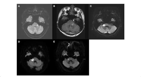 FIGURE The MRI findings of the five patients with posterior fossa ...