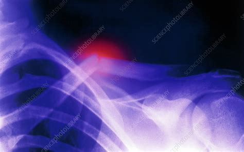 Col X-ray image showing a fractured clavicle - Stock Image - M330/0437 ...