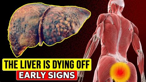 14 Early Signs That Your LIVER IS DYING People With Liver Problems Don