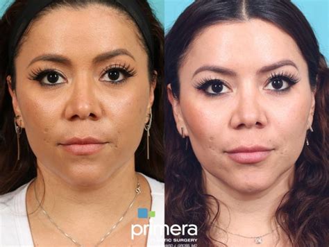 Buccal Fat Removal Before And After Pictures Case Orlando Tampa