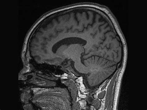 No Harm Seen In Mri Gadolinium Retention In Brain Fda Says