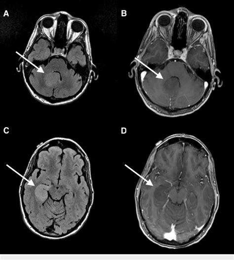 Axial FLAIR and T1 MRI with contrast demonstrating non-enhancing FLAIR ...