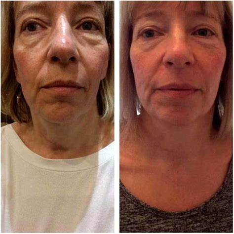 HIFU Before And After Pics (2) » Facelift: Info, Prices, Photos ...