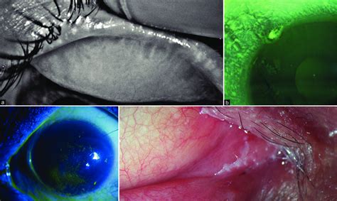 Dry Eye And Ocular Surface Disease Caused By Various Systemic And Download Scientific Diagram