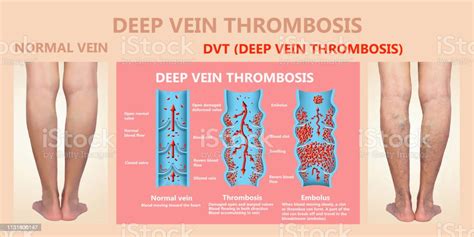 深靜脈血栓形成或血塊栓子 照片檔及更多 腿 照片 腿 動脈 血管 血凝結 Istock