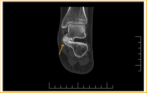 Subtalar talocalcaneal coalition-CT - Sumer's Radiology Blog