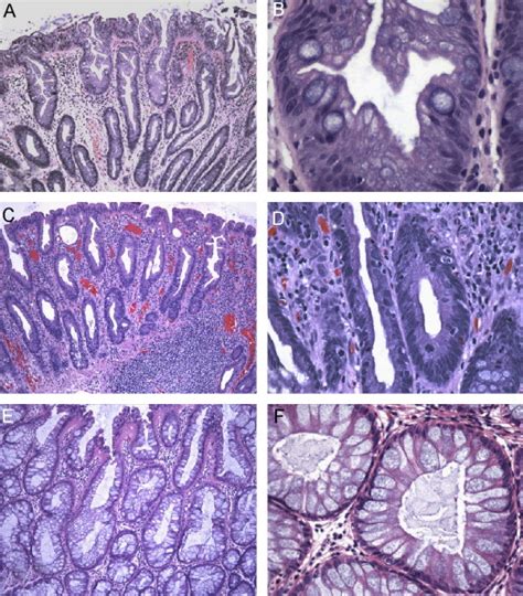 Serrated Polyps Critical Precursors To Colorectal Cancer