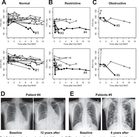 Figure 1 From Changes In The Pulmonary Function Test After Radioactive