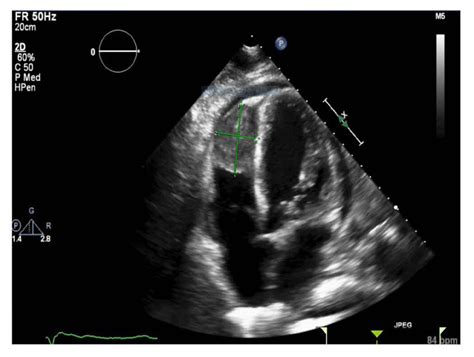 Echocardiogram: Transthoracic (TTE) | Download Scientific Diagram