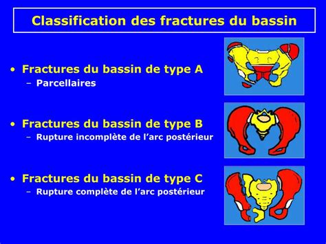 Ppt Fractures Du Bassin Powerpoint Presentation Free Download Id