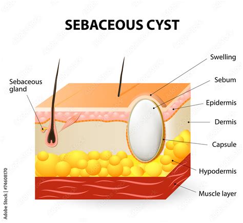 Sebaceous Cyst Or Trichilemmal Cyst Stock Vector Adobe Stock