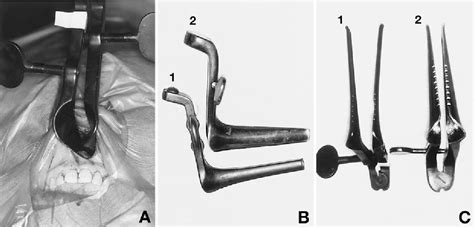 Figure 2 From Less Invasive Sublabial Unilateral Transseptal Approach