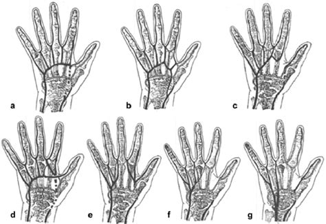 Figure From Pattern Of Variations In Superficial Palmar Arch In