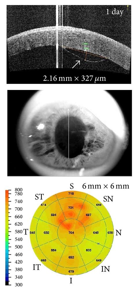 Spontaneous Resolution Of A Detachment Of Descemet’s Membrane Following Download Scientific