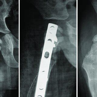 Natural course of a late presentation of Perthes disease (a) X-ray ...