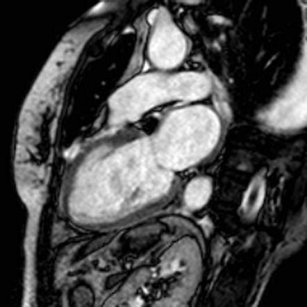 Takotsubo Cardiomyopathy Image Radiopaedia Org