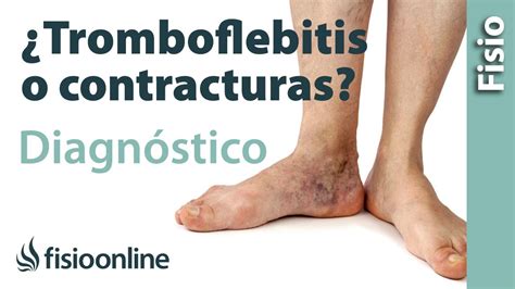 Cómo diferenciar una tromboflebitis de un dolor muscular de la