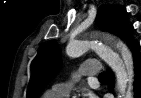 Proximal Aortic Perforation After Endovascular Repair Of A Type B