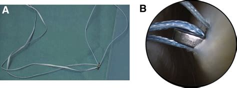 A Fibertape Loaded On The Tightrope Button B Visualization Of The