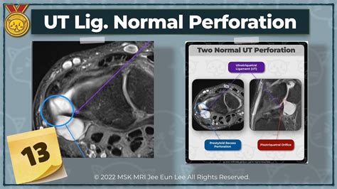 Anatomy13 Ulnotriquetral Ligament Two Normal Perforation