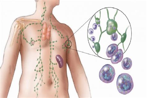 Lenf Lenfoma Kanseri Nedir Lenf Kanseri Belirtileri Nelerdir Ve