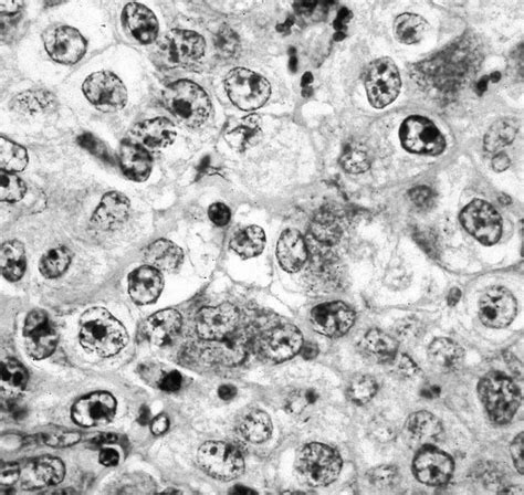 Pathology Outlines Adenosquamous Carcinoma