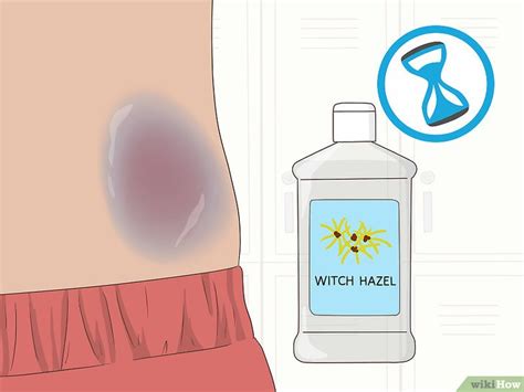 How To Make Bruises Go Away Quickly Effective Easy Ways