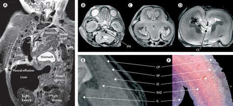 Post Mortem Examination Of Human Fetuses A Comparison Of Whole Body