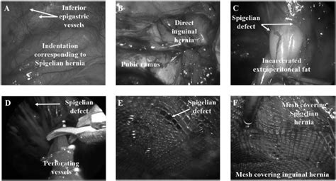 Intraoperative Views Of A Patient From Figure 1 Presenting With