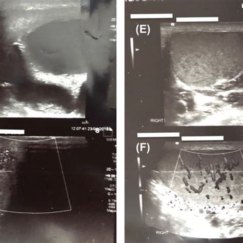 (PDF) Be cautious of “complex hydrocele” on ultrasound in young men