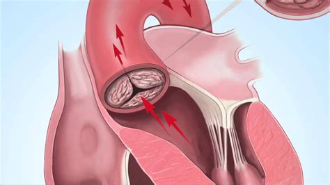 Understanding Aortic Stenosis With Dr Marc Gillinov Youtube