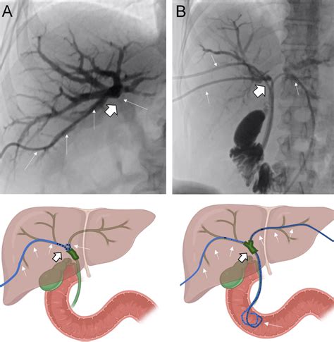 Transhepatic Percutaneous Cholangiography For Placement Of Biliary